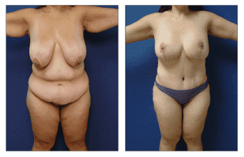 Plastic Surgery After Weight Loss Plastic Surgery After Weight Loss