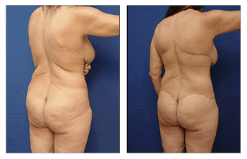 Bariatric tummy tuck before and after photos.