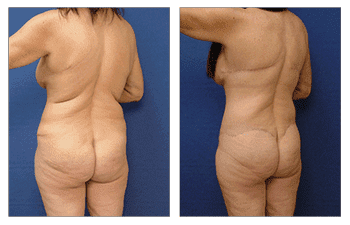 See the transformative results of a tummy tuck procedure, showcasing stunning before and after photos.