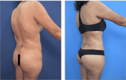 Too Thin for a Skinny BBL Too Thin for a Skinny BBL