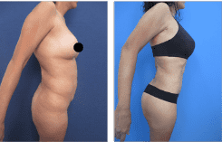 Too Thin for a Skinny BBL Too Thin for a Skinny BBL
