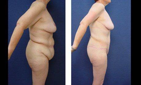 orange county brachioplasty newport beach patient 9 right orange county brachioplasty newport beach patient 9 right