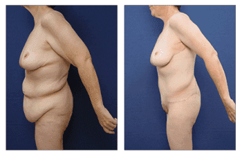 orange county brachioplasty newport beach patient 9 front right orange county brachioplasty newport beach patient 9 front right
