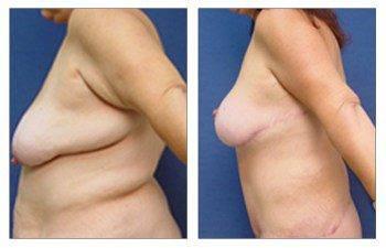 brachioplasty surgery left view brachioplasty surgery left view