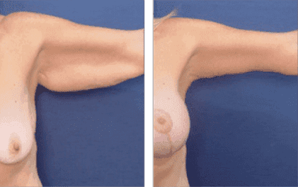 Arm Lift Recovery Arm Lift Recovery