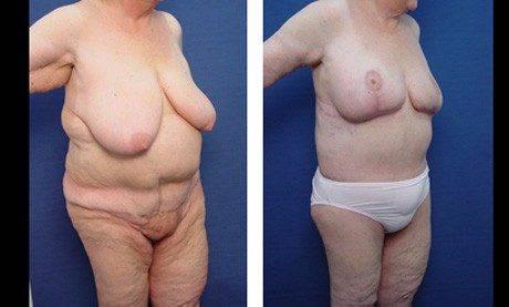 brachioplasty patient 4 front right brachioplasty patient 4 front right