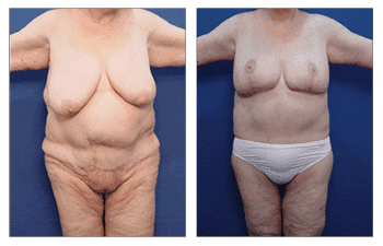 brachioplasty patient 4 front view brachioplasty patient 4 front view