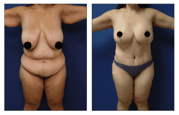 Post Bariatric Surgery Diet Post Bariatric Surgery Diet