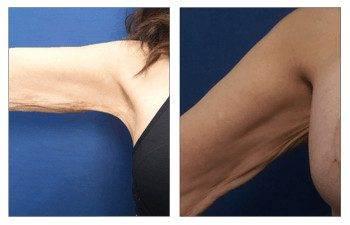 Arm Lift Surgery without a Scar Arm Lift Surgery without a Scar