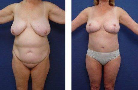 High Definition Arm Contouring, ARM LIFT SURGERY High Definition Arm Contouring, ARM LIFT SURGERY
