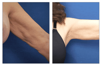 Arm Lift Surgery without a Scar Arm Lift Surgery without a Scar