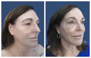 Attiva Radiofrequency Skin Treatment Before And After