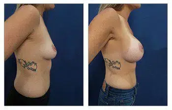 A woman's breast before and after surgery, focusing on Avoiding Breast Asymmetry. A woman's breast before and after surgery, focusing on Avoiding Breast Asymmetry.