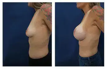 A woman's breast before and after breast augmentation surgery. A woman's breast before and after breast augmentation surgery.