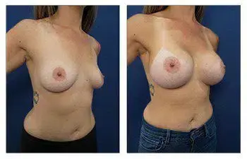 A woman's breast before and after surgery, emphasizing the importance of avoiding breast asymmetry during breast augmentation. A woman's breast before and after surgery, emphasizing the importance of avoiding breast asymmetry during breast augmentation.