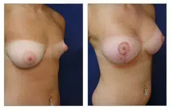 A woman's breast before and after surgery for Avoiding Breast Implant Malposition. A woman's breast before and after surgery for Avoiding Breast Implant Malposition.