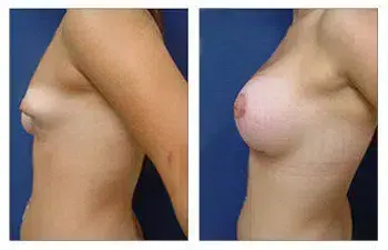 A woman's breast before and after surgery, highlighting successful avoidance of Breast Implant Malposition. A woman's breast before and after surgery, highlighting successful avoidance of Breast Implant Malposition.