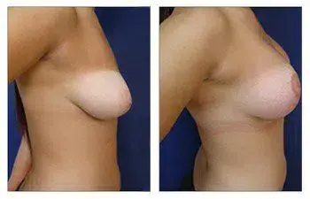 A woman's breast before and after surgery, ensuring Avoiding Breast Implant Malposition. A woman's breast before and after surgery, ensuring Avoiding Breast Implant Malposition.