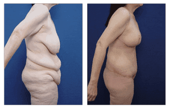orange county brachioplasty newport beach patient 8 right orange county brachioplasty newport beach patient 8 right