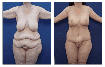 arm band deformity surgery before and after arm band deformity surgery before and after