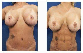 hdl patient before and after hdl patient before and after