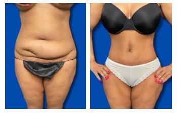 Awake Liposuction Near Me — before and after results Awake Liposuction Near Me — before and after results