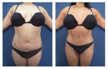 Awake Tummy Tuck Awake Tummy Tuck