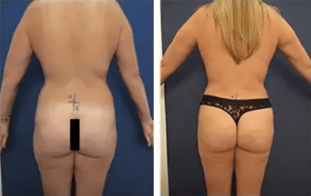 Brazilian Buttocks Lift (BBL)