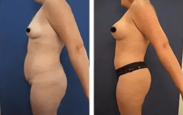 Brazilian Buttocks Lift (BBL)