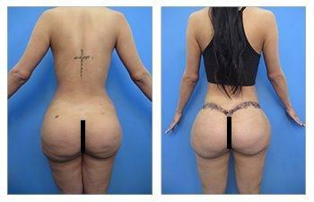 Skinny BBL Surgeons — patient photo Skinny BBL Surgeons — patient photo