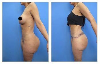 BBL Reduction — patient photo BBL Reduction — patient photo