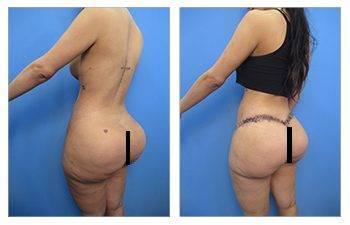 Maximizing Buttock Augmentation — patient photo Maximizing Buttock Augmentation — patient photo