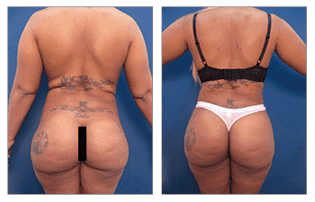 Before and after revision by one of the best BBL Revision Doctors Before and after revision by one of the best BBL Revision Doctors