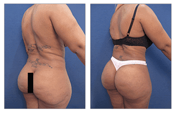 Before and after revision by one of the best BBL Revision Doctors Before and after revision by one of the best BBL Revision Doctors