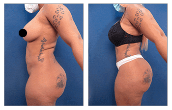 Tummy tuck before and after transformation achieved by skilled BBL Revision Doctors. Tummy tuck before and after transformation achieved by skilled BBL Revision Doctors.