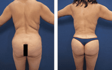 BBL revision before and after photos. BBL revision before and after photos.