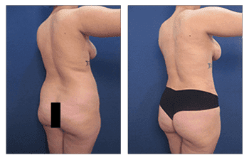 Before and after pictures of a woman's tummy tuck in preparation for a BBL revision. Before and after pictures of a woman's tummy tuck in preparation for a BBL revision.