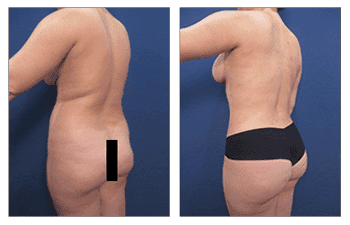 After surgery image of a BBL revision preparation After surgery image of a BBL revision preparation