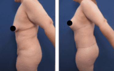 BBL revision using lateral thigh and buttock lift