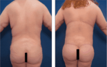 BBL-revision-using-lateral-thigh-and-buttock-lift-2
