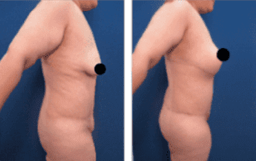 BBL revision using lateral thigh and buttock lift