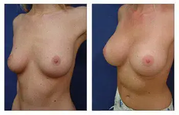 A woman's breast before and after undergoing surgery by the best breast augmentation surgeon. A woman's breast before and after undergoing surgery by the best breast augmentation surgeon.