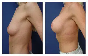 Before and after breast augmentation surgery. Before and after breast augmentation surgery.