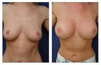 The before and after transformation of a woman's breast surgery performed by the best breast augmentation surgeon. The before and after transformation of a woman's breast surgery performed by the best breast augmentation surgeon.