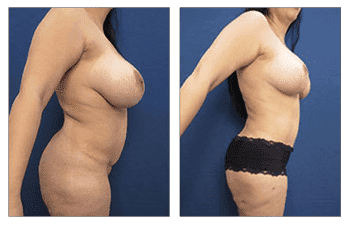 Combining tummy tuck with Lipo - view incredible before and after results! Combining tummy tuck with Lipo - view incredible before and after results!