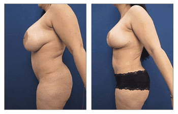 A woman's butt before and after Liposuction and Tummy Tuck surgery. A woman's butt before and after Liposuction and Tummy Tuck surgery.