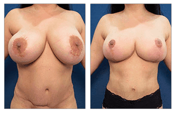 The transformation of a woman's breasts before and after breast surgery, showcasing the remarkable results of a breast lift revision. The transformation of a woman's breasts before and after breast surgery, showcasing the remarkable results of a breast lift revision.