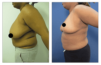 Best Breast Reduction Best Breast Reduction