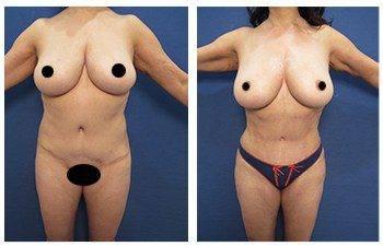 Best female abdominal contouring Best female abdominal contouring