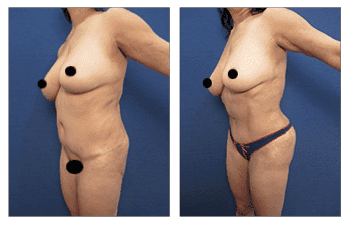 Best female abdominal contouring Best female abdominal contouring